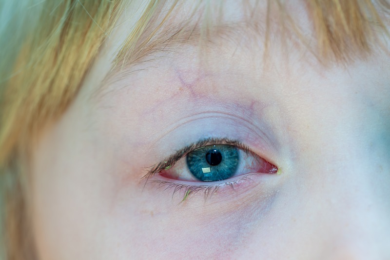 氟康唑滴眼液的主治作用是什么
